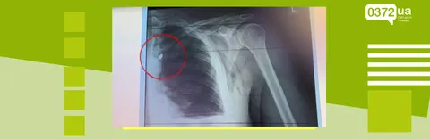 Сантиметр від аорти: у Чернівцях врятували чоловіка з двома кулями в тілі