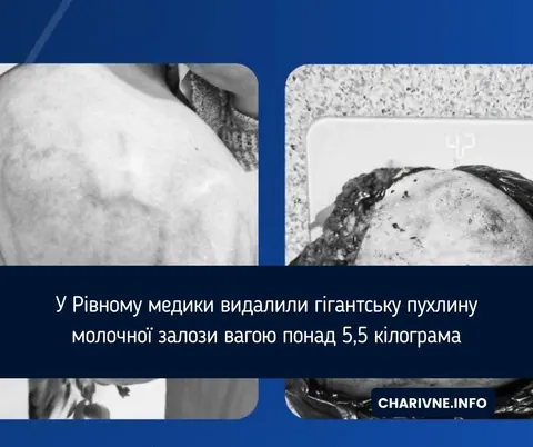 У Рівному лікарі видалили пацієнтці пухлину грудей вагою понад 5,5 кг